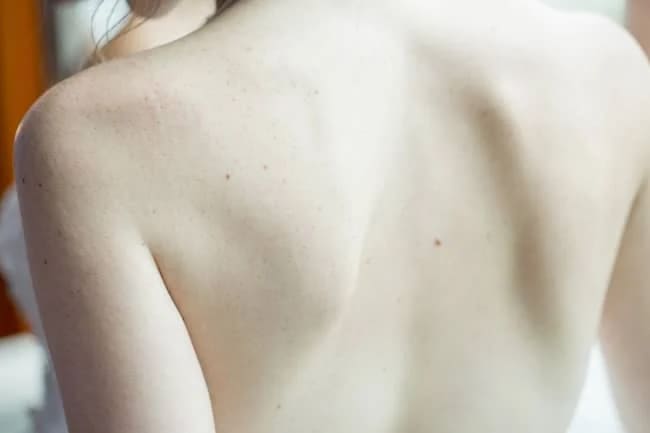 woman s back with white birthmarks