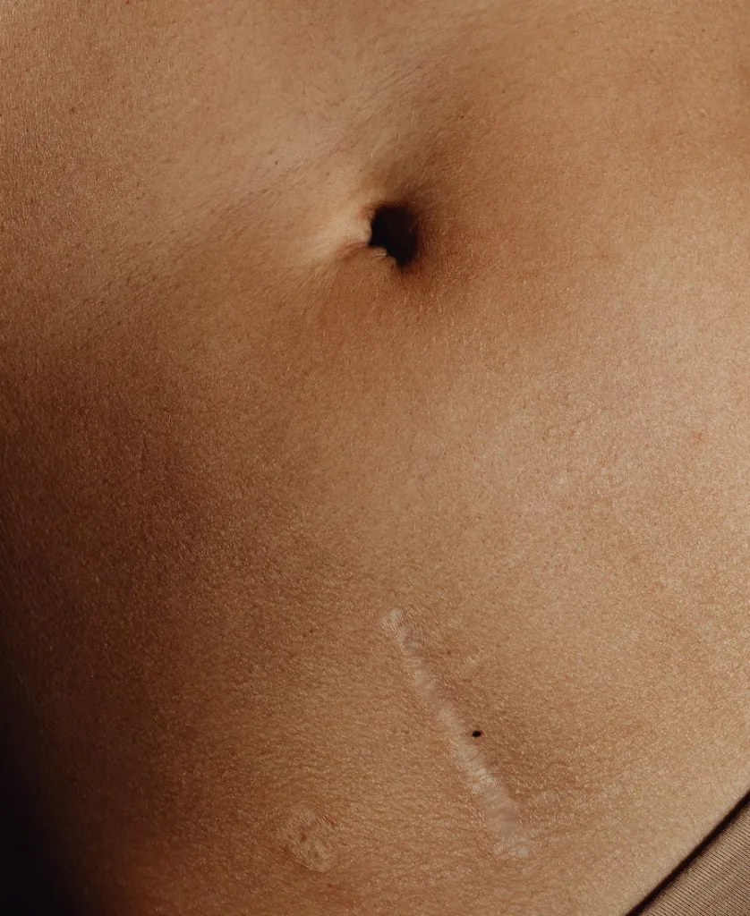 belly button of a woman with scars