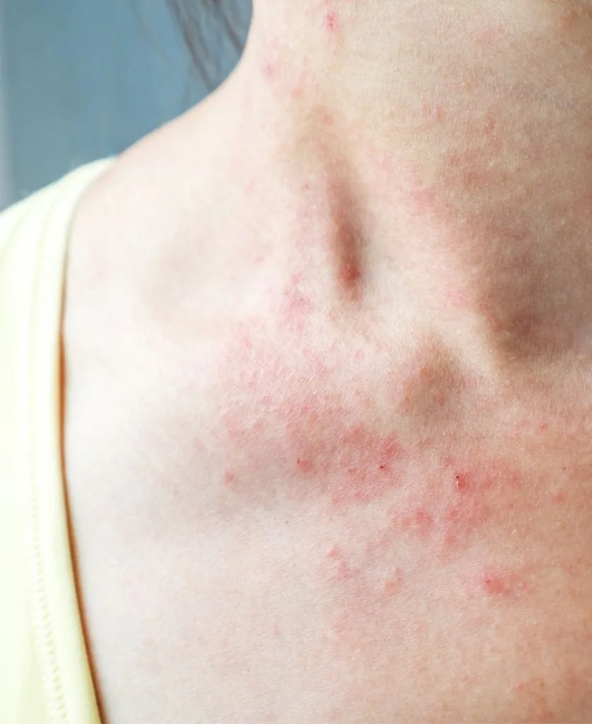 Eczema on a woman's collarbone