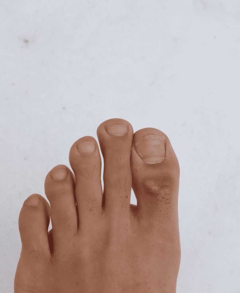 Foot with Mortons Toe