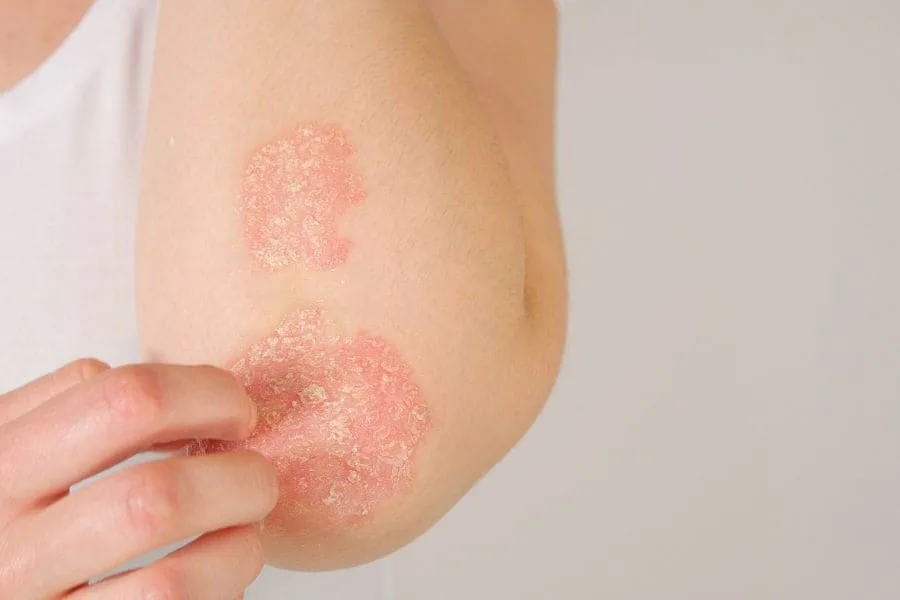 Spiritual Meaning of Eczema: 5 Powerful Messages